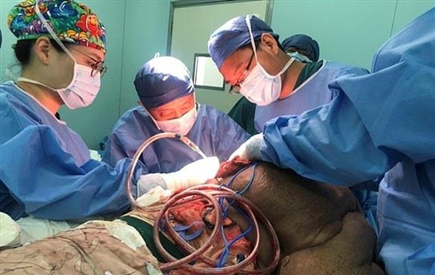 Китайцу удалили 30-летнюю опухоль весом 15 килограмм