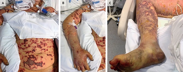 Студент доел чужую лапшу и лишился ног