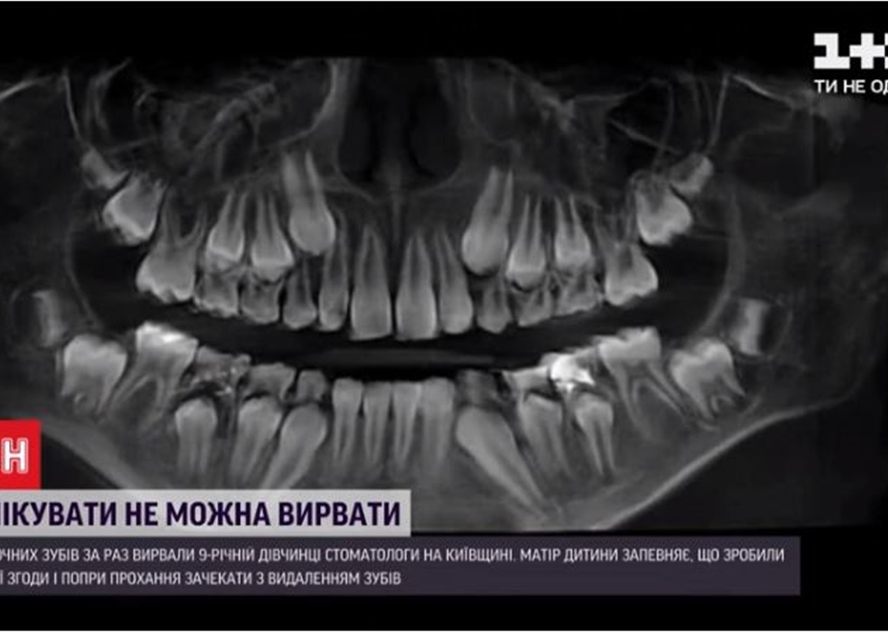 Под Киевом стоматолог удалил ребенку 12 зубов без согласия родителей - СМИ  - Korrespondent.net