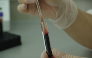 Медики назвали основные симптомы образования тромбов