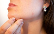 Experts have called eating habits that harm the skin