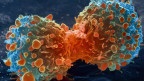 Жінки до 40 років хворіють на рак грудей дедалі частіше