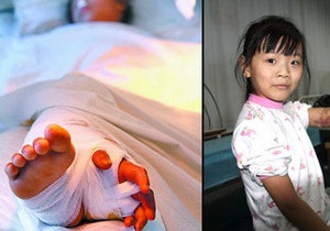 Китайские хирурги сохранили девочке оторванную руку, пришив ее к ноге