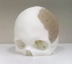 Новости медицины: Американским хирургам удалось восстановить 75% черепа человека с помощью 3D-печати