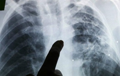 Туберкульоз за небезпечністю порівняли зі СНІДом
