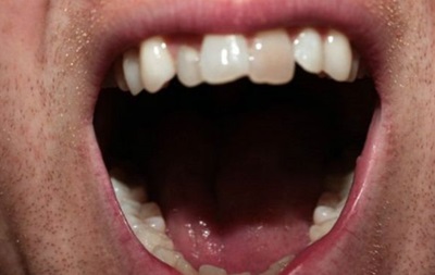 Професійні футболісти потерпають через погані зуби