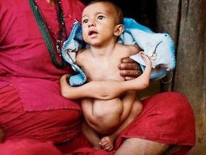 Непальцы поклоняются ребенку, родившемуся с четырьмя парами конечностей