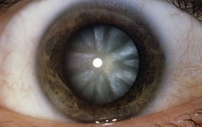У Китаї науковцям вдалося регенерувати кришталик ока