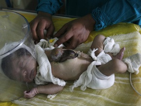 В Индии родился ребенок с сердцем снаружи
