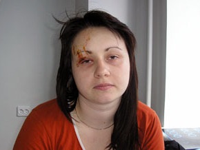 У девушки, пострадавшей в ДТП с участием Лавриновича, - отек мозга