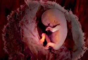 В американском штате запретили аборты при выявлении синдрома Дауна