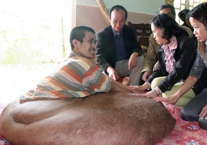 Вьетнамец живет с 80-килограммовой опухолью на ноге