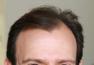 Исследование: Облысение снижает риск заболевания раком простаты