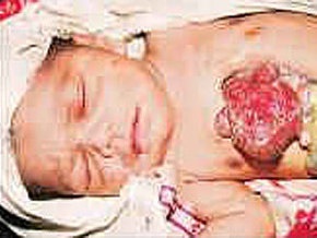 В Индии родился младенец с внешним сердцем