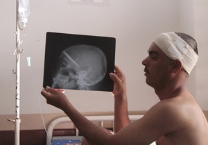Бразильские медики удалили из головы мужчины нож, с которым тот прожил три года