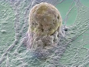 Лечение стволовыми клетками привело к появлению опухолей у подростка