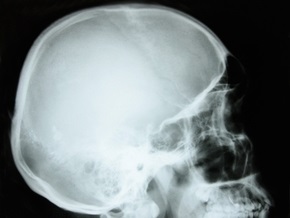 Уникальный случай регенерации: у 74-летнего мужчины восстановился фрагмент черепа