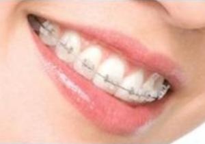 Брекеты и пирсинг – особая гигиена