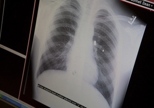 Киевлян приглашают бесплатно сделать рентген легких