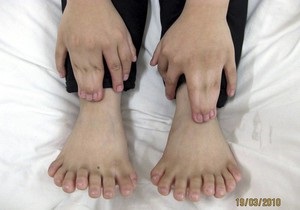 В Китае мальчику удалили 11 лишних пальцев