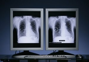 Новости медицины - рак легких - диагностика: Рак легких научились диагностировать по дыханию
