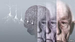 Ранню стадію хвороби Альцгеймера визначатимуть за аналізом крові