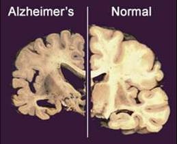 У США почалися випробування стимулятора мозку проти хвороби Альцгеймера