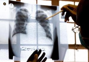 DW: Епідемія хіміорезистентного туберкульозу. Україна – в зоні ризику