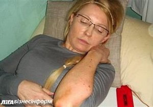 В інтернет потрапили фото гематом Тимошенко