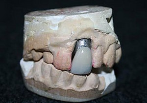 В Англії на аукціон виставлять гіпсовий зліпок зубів Елвіса Преслі
