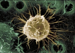 Стовбурові клітини випробовують проти інсульту