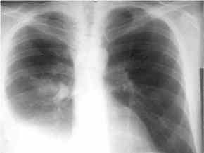 Епідемію туберкульозу в Харківській області не зупинено