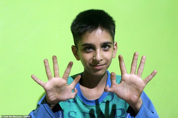 Мальчику из Индии лишние пальцы помогают достигать успехов. ФОТО