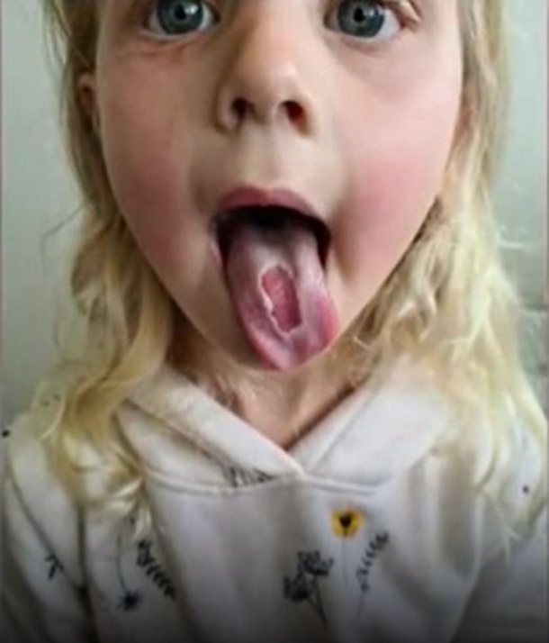 Четырехлетняя девочка получила ожог языка из-за леденцов (фото)