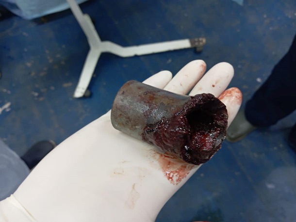 Лікарі вилучили з ноги бійця частину касетного боєприпасу (фото)
