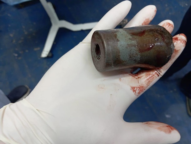 Лікарі вилучили з ноги бійця частину касетного боєприпасу (фото)