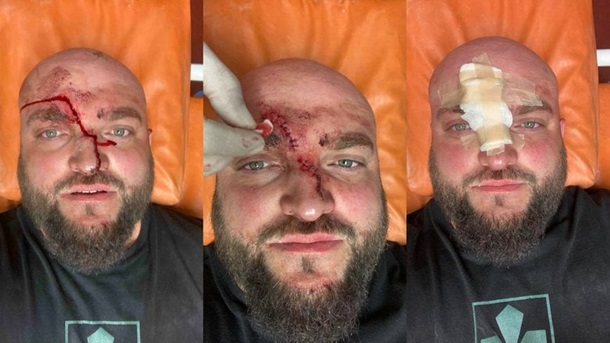 В Затоке местный житель избил ветерана АТО за просьбу выключить русскую музыку В Затоке местный житель избил ветерана АТО за просьбу выключить русскую музыку