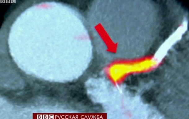 Радиация поможет британским ученым бороться с инфарктом