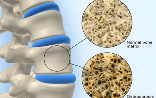 Остеопороз - скрытая угроза