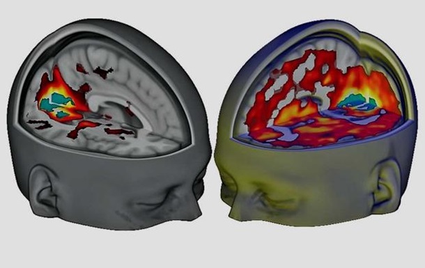 Мозок людини під ЛСД вперше вивчили через МРТ