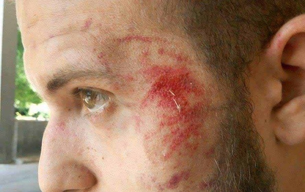 ОБСЄ закликає розслідувати напад на журналіста в Запоріжжі