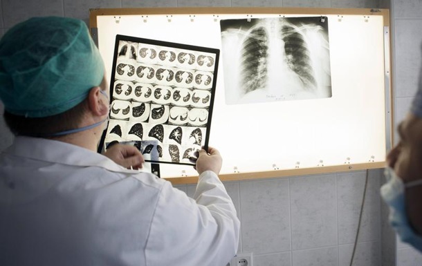 ВООЗ назвала туберкульоз найбільш смертоносною хворобою в світі