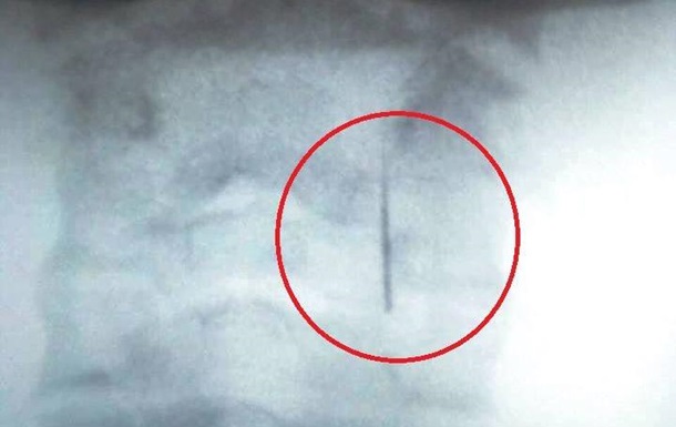 В Ужгороді стоматолог  загубив  голку в горлі дитини