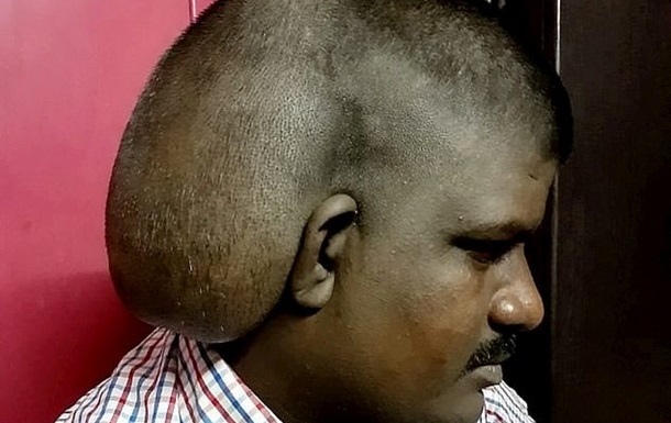 В Індії чоловікові видалили величезну пухлину на голові