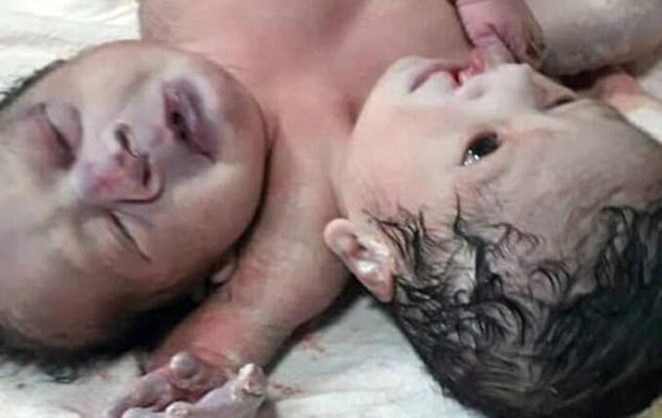 В Індії народилася двоголова і трирука дитина