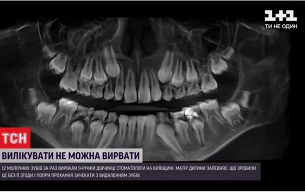 Під Києвом стоматолог видалив дитині 12 зубів без згоди батьків - ЗМІ