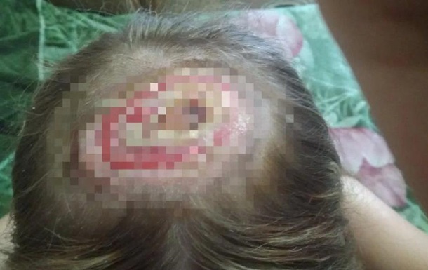 Під Рівним дівчина отримала опіки голови III ступеня в перукаря