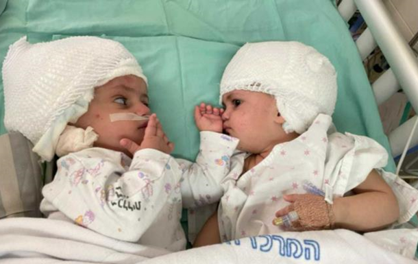 В Ізраїлі успішно розділили сіамських близнюків