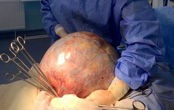 В Кропивницком онкологи удалили опухоль весом в 10 кг
