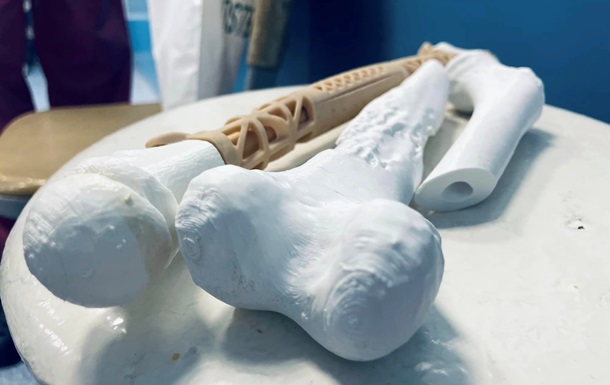 У Львові дитині пересадили кістку, надруковану на 3D-принтері